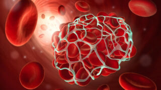 Blood Advances Study Reveals Misclassification of Venous Thromboembolism (VTE) Risk