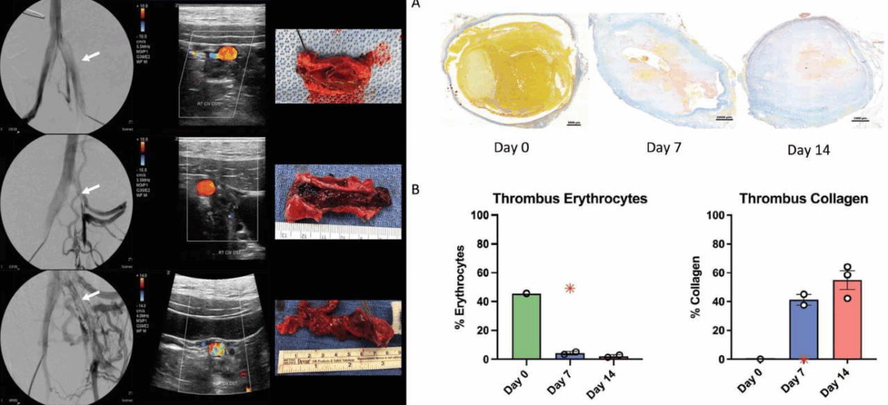 How do the mechanical properties of a venous thrombus change over time? – VascularMedicine