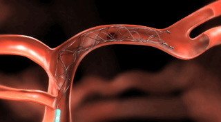 Nick Murray Shares Nationwide Data on Thrombectomy Outcomes in CVST