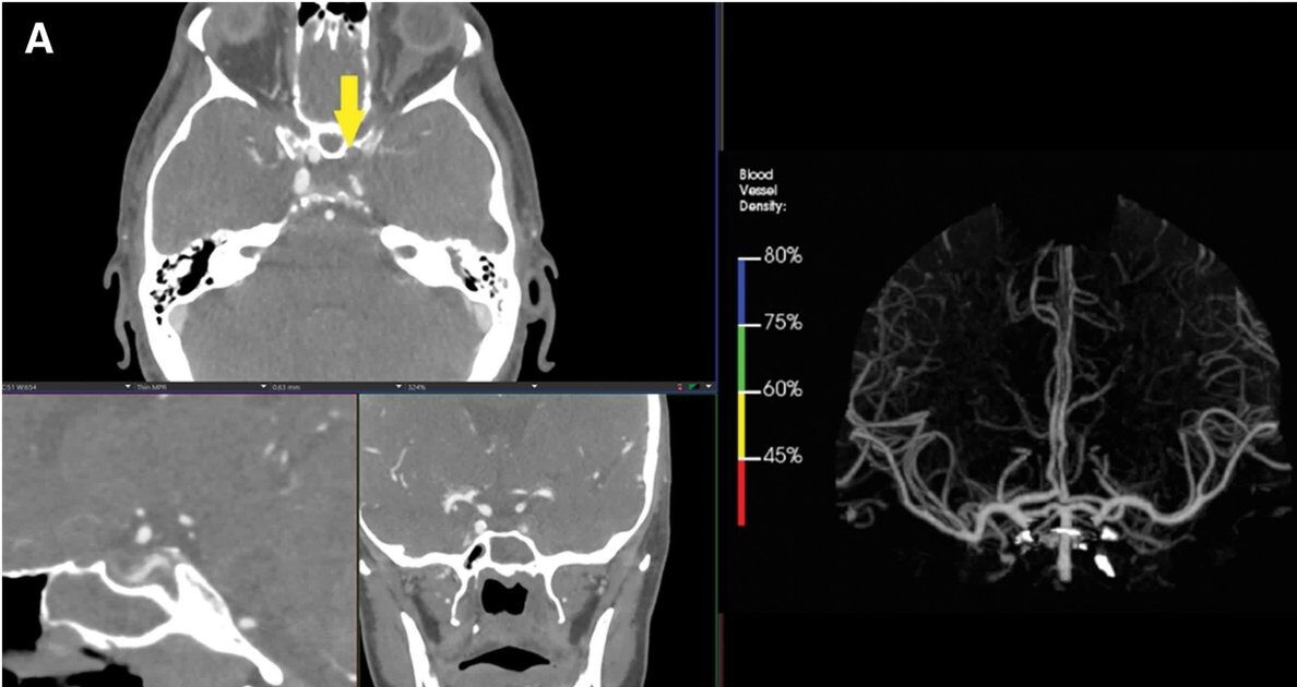 AI and STROKE: Evidence on Software Performance in a Real-world Setting