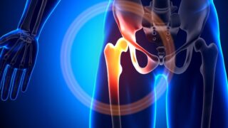 Journal Hemophilia on Bone Health | Vitamin D, DEXA Scans and Bleeding Disorders?