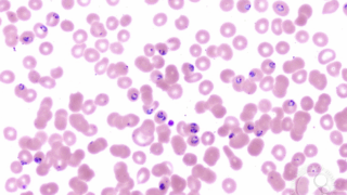 Nihar Desai: A 35 Year Old Man Presents with High Grade Fever...