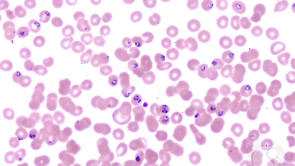 Nihar Desai: A 35 Year Old Man Presents with High Grade Fever…