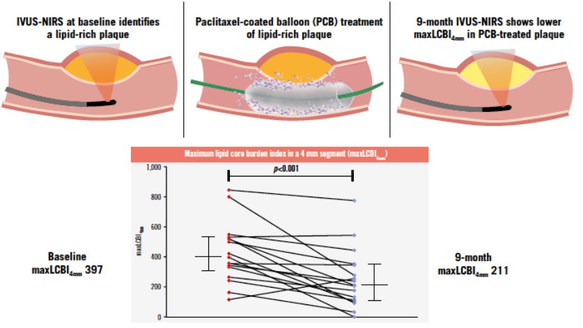 Study Explored the Use of Paclitaxel-Coated Balloons for Stabilizing Vulnerable Lipid-Rich Plaques in ACS Patients – EuroIntervention