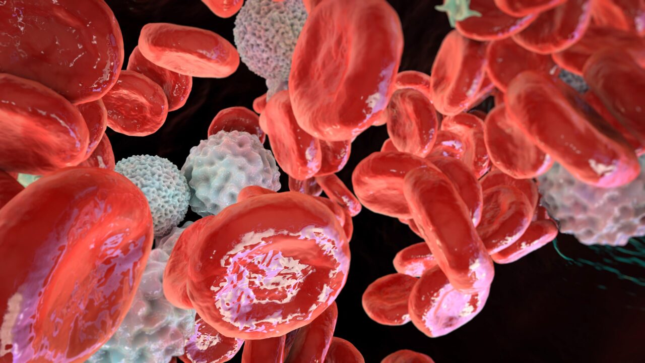 Pulmonary Hypertension Shortens Survival in Polycythemia Vera