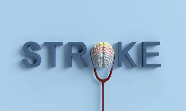 TATAM RCT Demonstrates Superior Angiographic Outcomes with Transvenous Embolization in Stroke Management – Stroke AHA/ASA