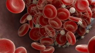 Thrombosis with Thrombocytopenia, Post Vaccination Syndrome