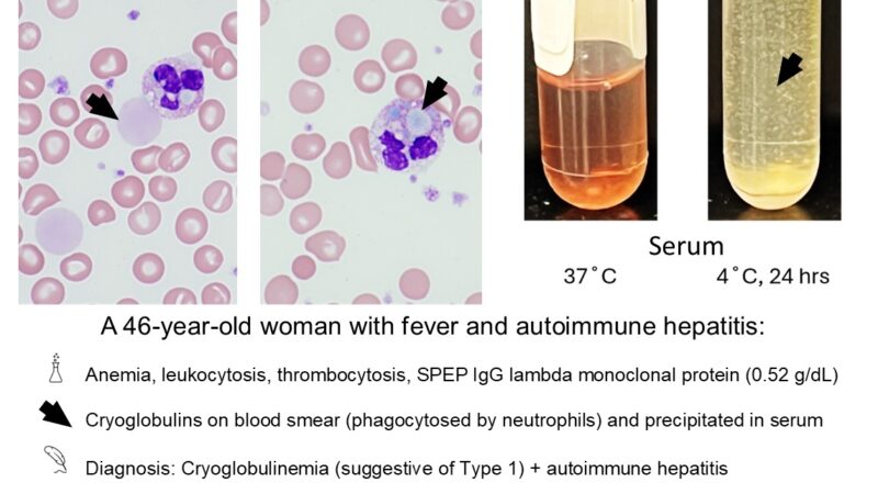 Cryoglobulinemia 