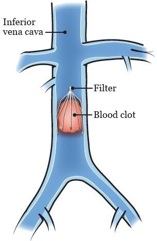 IVC filter