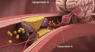Lipoprotein(a) and Stroke Risk in Over 16,000 Hispanic/Latino Adults: Emerging Insights From the HCHS/SOL Study