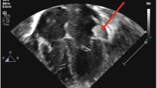 A Neonatal 1st: Shocking Intracardiac Thrombosis Tied to Maternal aCL Antibodies