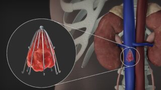 IVC Filters Under the Spotlight: What Every Clinician Should Know