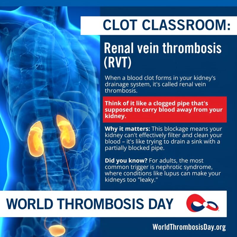 Clot Classroom: Meaningful Insights into Renal Vein Thrombosis Awareness