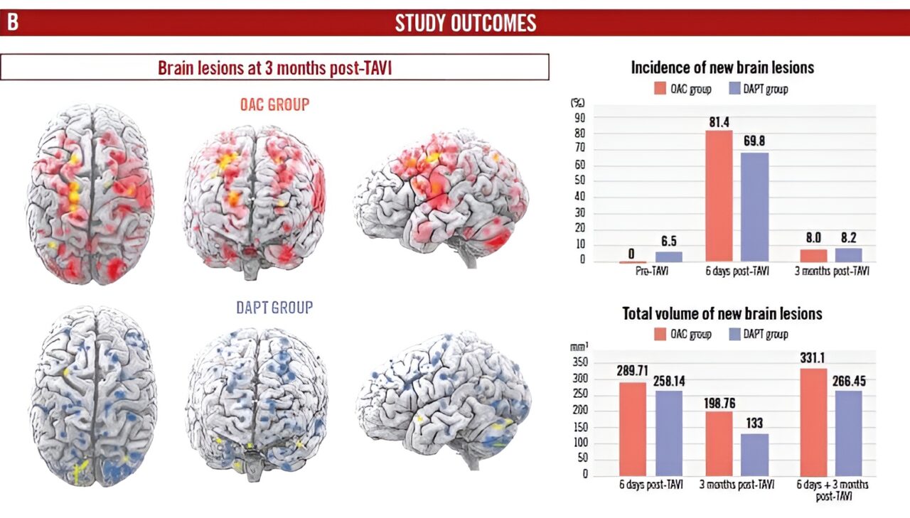 AUREA Trial’s Decisive 90 Days: DAPT Shows Advantage Over OAC in Cerebral Protection post-TAVI?