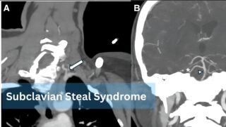 1 in 100: Subclavian Steal Syndrome Revealed by LVO Stroke in Case with Persistent Trigeminal Artery