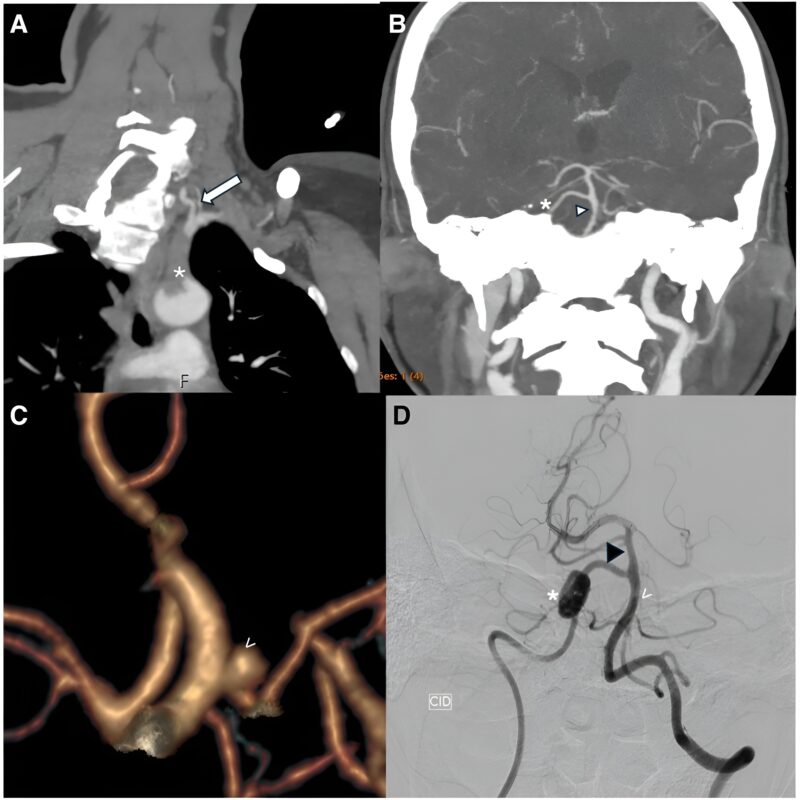 1 in 100: Subclavian Steal Syndrome Revealed by LVO Stroke in Case with Persistent Trigeminal Artery