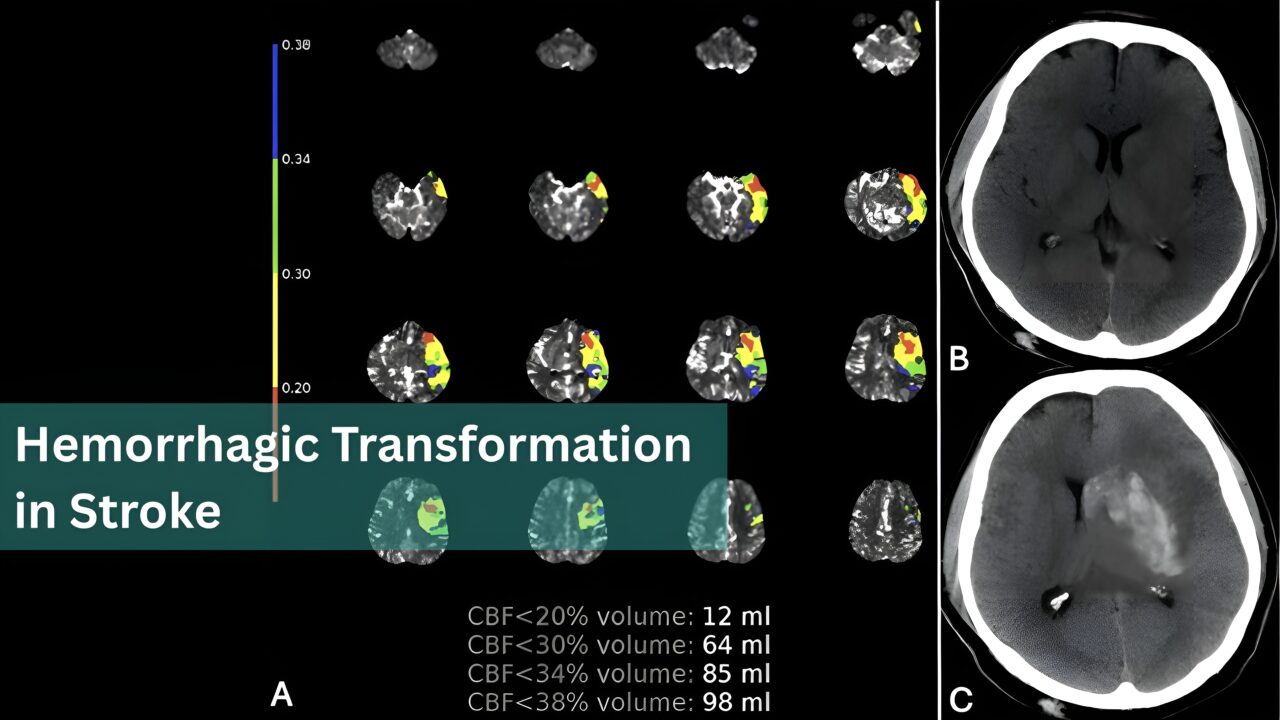 Time and Severe Hypoperfusion: 2 Threats for Hemorrhagic Transformation in Stroke