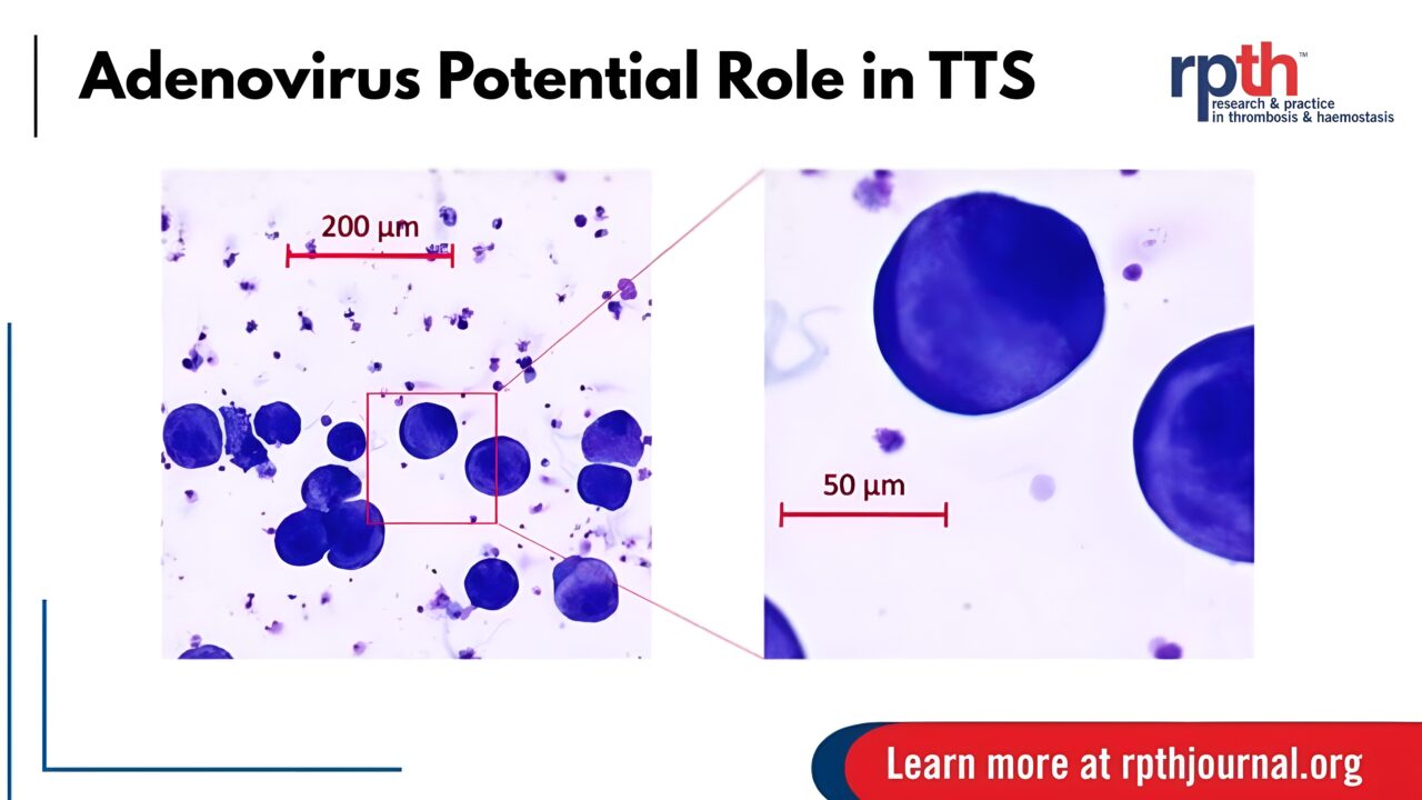 1 Hypothesis, Multiple Implications: Adenoviral Vector Vaccines and Thrombosis with Thrombocytopenia Syndrome