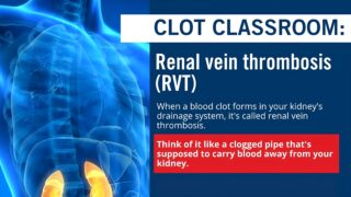 Clot Classroom: Meaningful Insights into Renal Vein Thrombosis Awareness