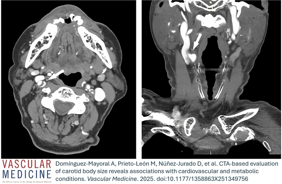 New Study Links Carotid Body Size to Cardiovascular and Metabolic Disorders