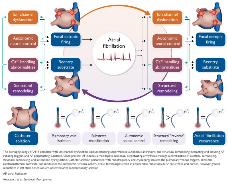 Is Atrial Remodeling the Key to Better Outcomes After AFib Ablation?