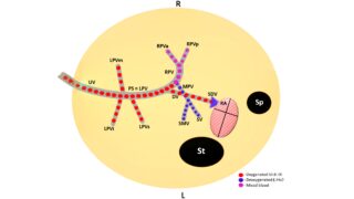 Shelly Czeiger: Novel Insights on Umbilical-Portal-Systemic Venous Shunt and Growth Restriction in a Prospective Study