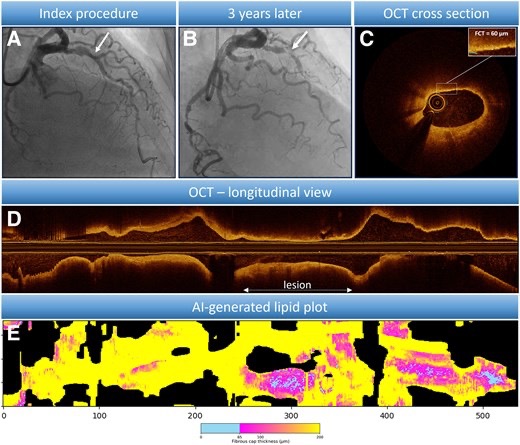 Filippo Crea Shares Some AI-Insights on Recurrent STEMI