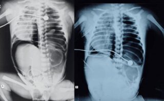 A Rare Case of Aortic Thrombosis in a Newborn With CDH