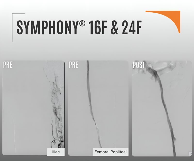 Impressive 95% Clot Removal in a VTE Case: Symphony16F and Symphony24F Catheters