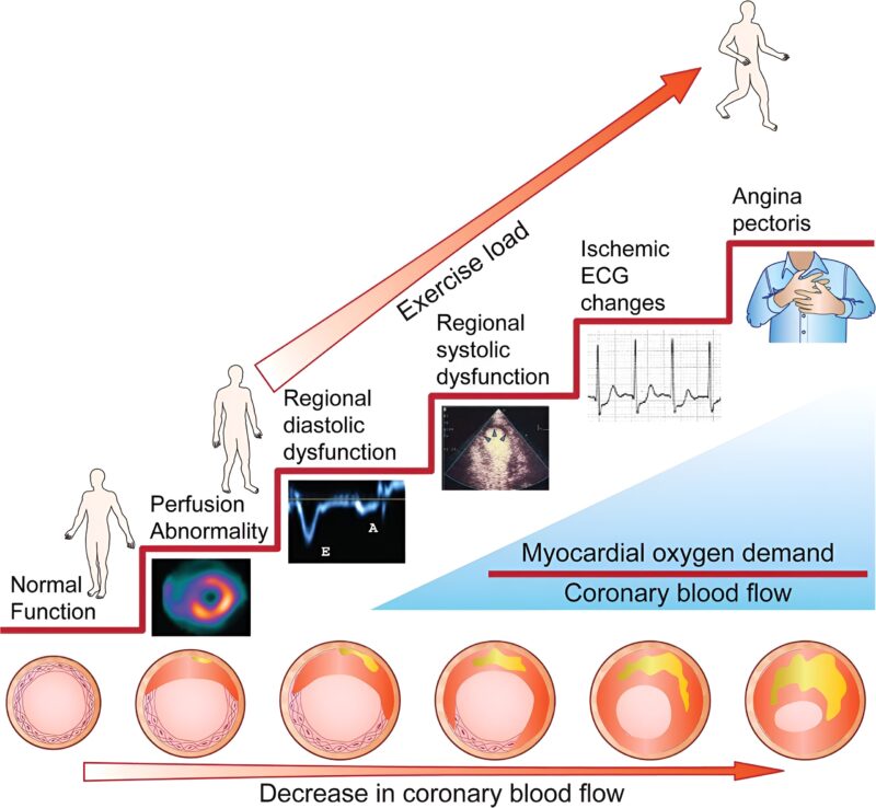 Cardiac Trials: Ischemia’s First Sign Is LVEDP Rise