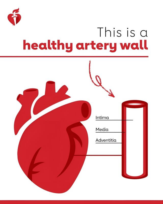 American Heart Association – Fighting Plaque Beyond the Smile