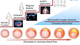 Cardiac Trials: Ischemia’s First Sign Is LVEDP Rise