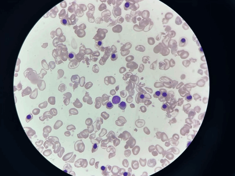 Beta Thalassemia Major After Splenectomy: Setareh Sheikhi Reports Striking nRBC Surge Reports Striking nRBC Surge