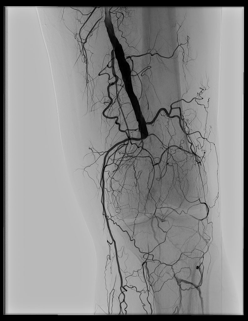 Nikolaos Galanakis: Percutaneous Mechanical Thrombectomy has Emerged as a Valuable Treatment Option in Acute Limb Ischemia
