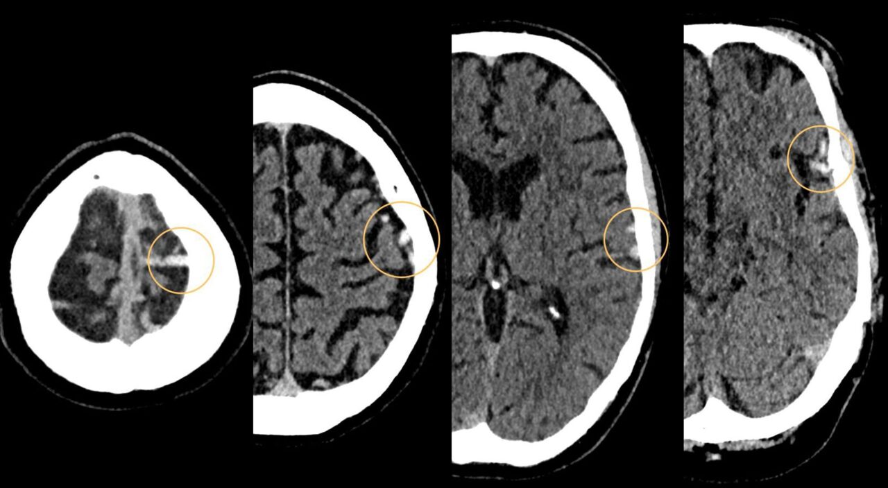 First-Time Generalized Seizure and Headache - Case Report