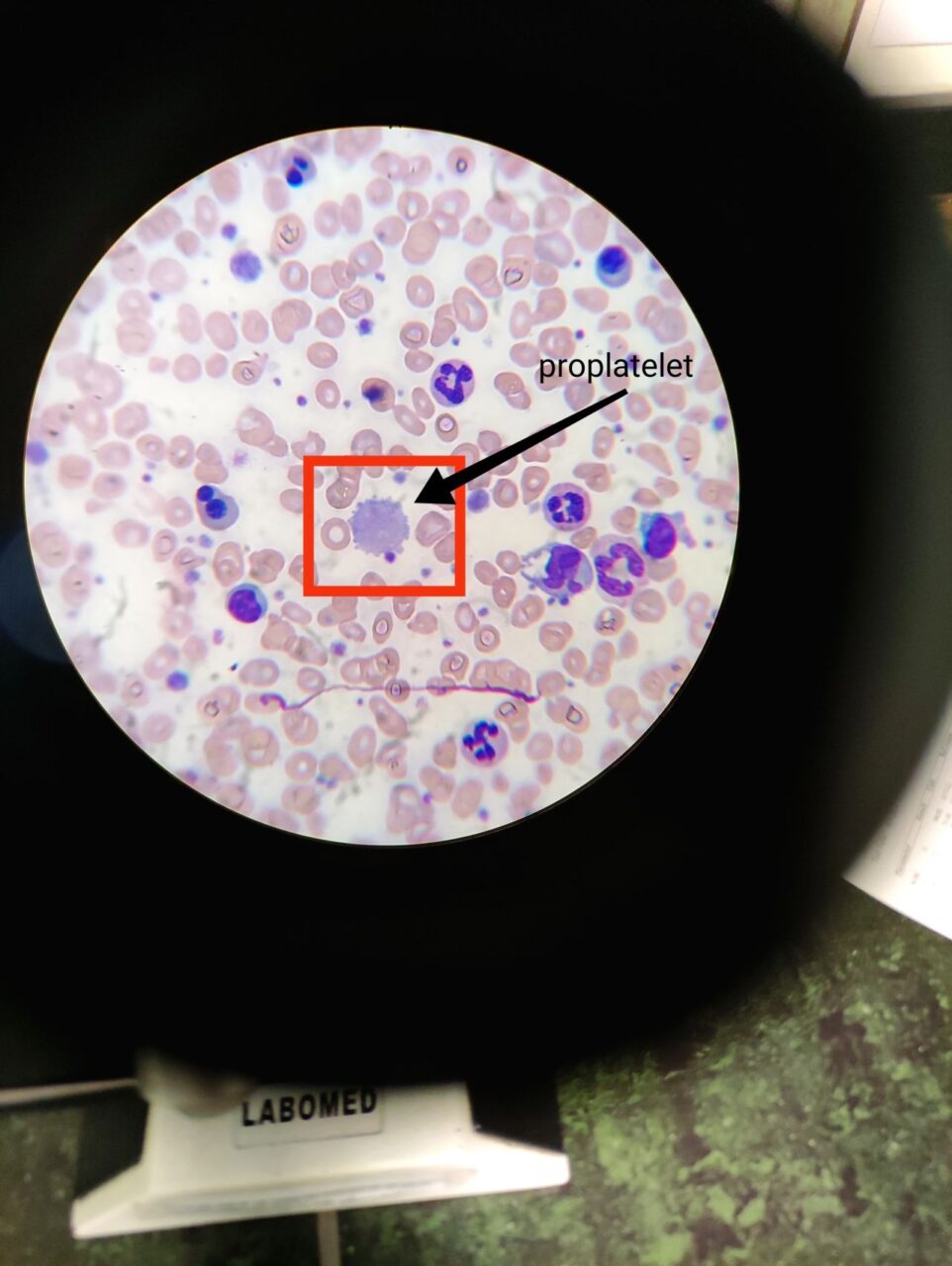 Mehdi Farahani Explains Proplatelet and Diagnosis Methods