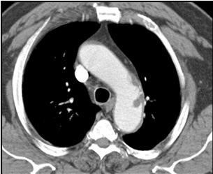 Aortic arch plaque