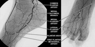 Pedal Circulation Status Found Crucial for Wound Healing in Chronic Limb-Threatening Ischemia