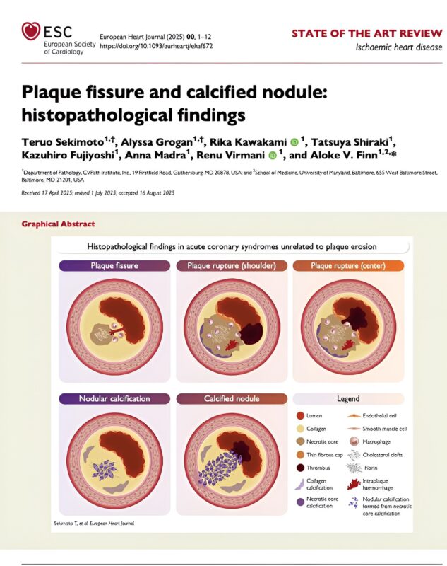 Plaque Fissure