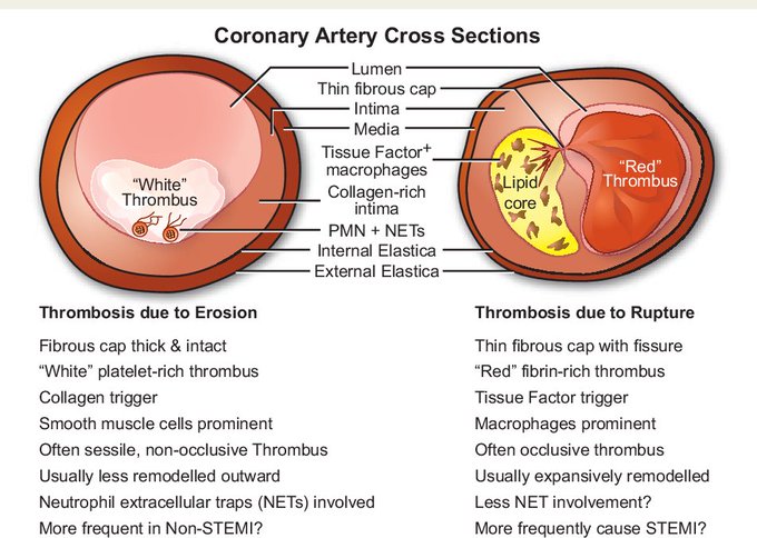 Thrombus