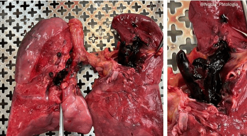 Pulmonary Thromboembolism 