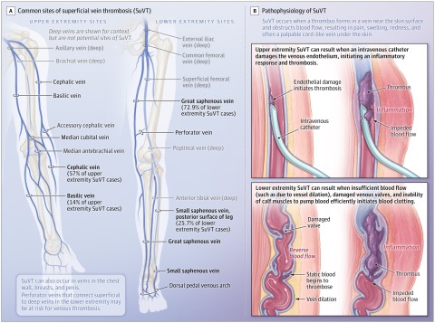 Gregory Piazza & Darsiya Krishnathasan: A Review on Superficial Vein Thrombosis