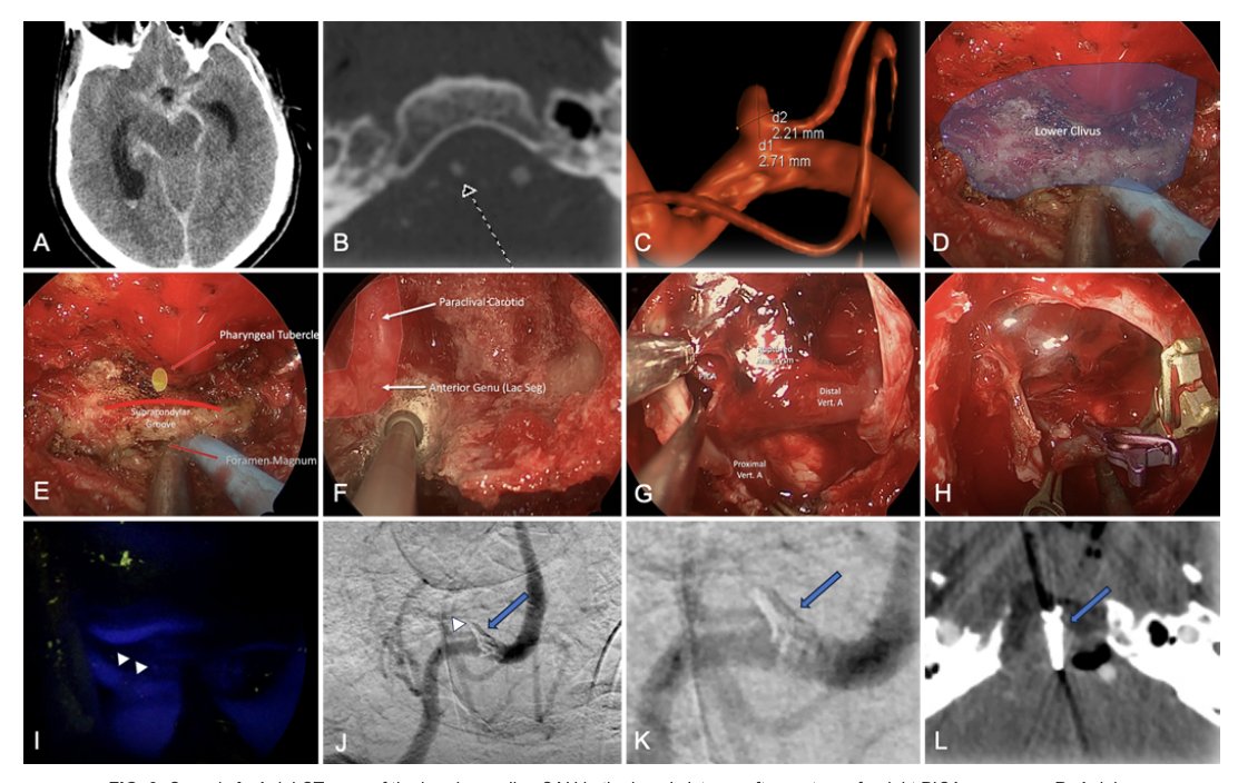 Endoscopic Endonasal Approach in Intracranial Aneurysms: Insights from 40 Cases