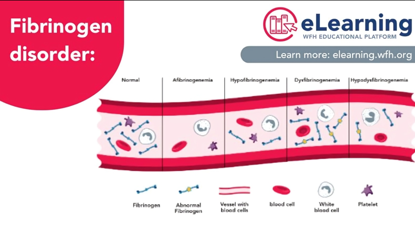 WFH eLearning Platform Explains the Different Types of Fibrinogen Disorders