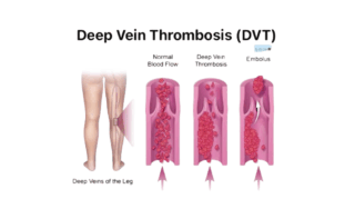 Deep Vein Thrombosis (DVT) Explained in One Slide: Causes, Symptoms, Diagnosis and Treatment