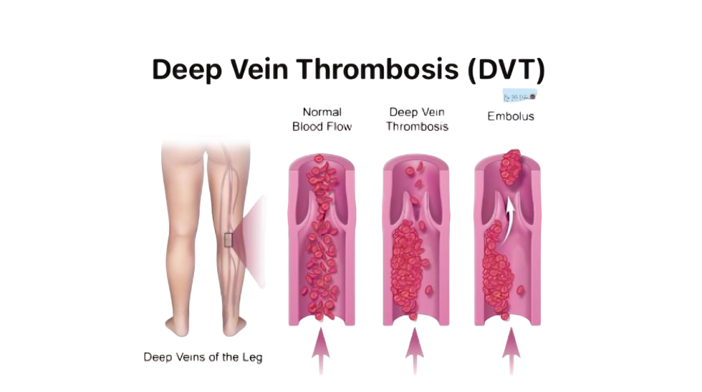 Deep Vein Thrombosis (DVT) Explained in One Slide: Causes, Symptoms, Diagnosis and Treatment