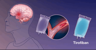 Boosting Stroke Thrombolysis․ Tirofiban Shows Promise in ASSET-IT Trial