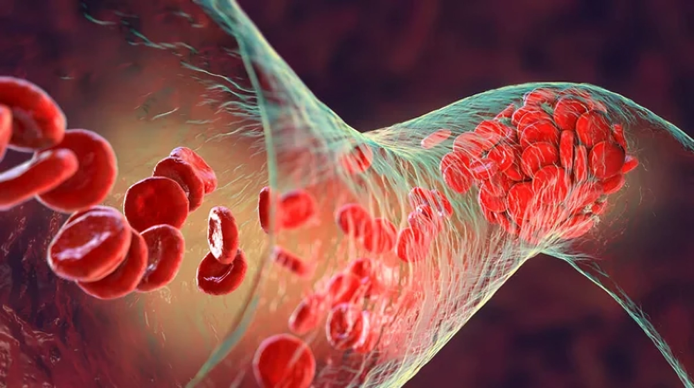 Survey on Rare Coagulation Factor Deficiencies: Share Your Insights