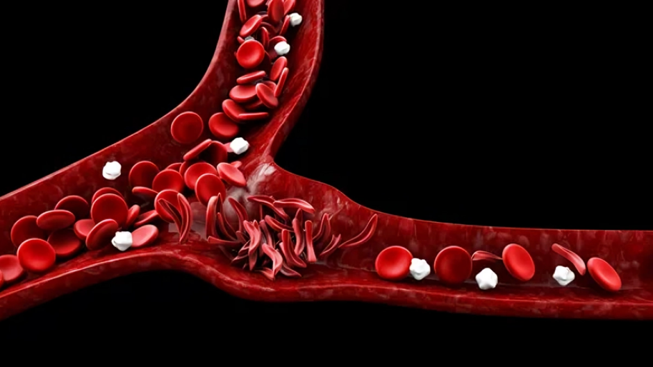 FWGBD Hosts Online Event – Women with Sickle Cell: Reproductive Health Matters