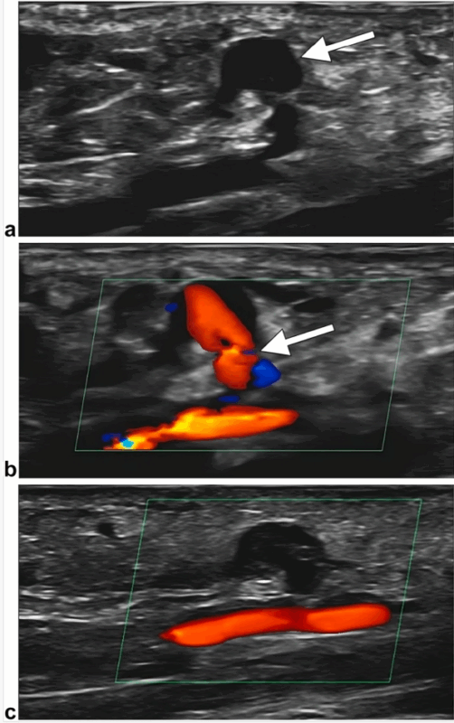 Pseudoaneurysm